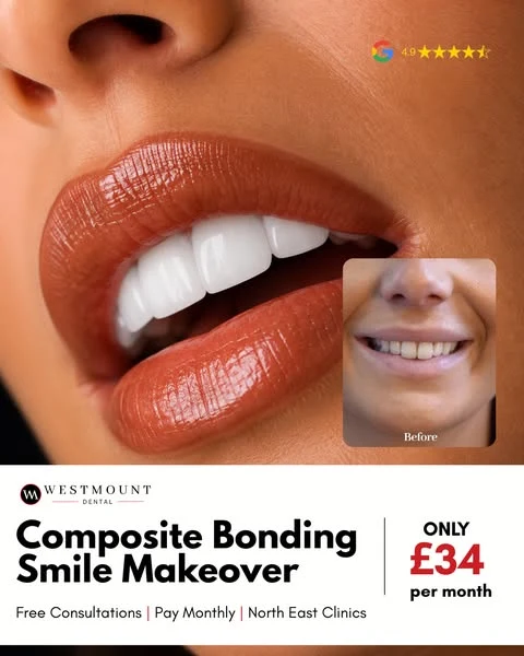Westmount Dental public composite bonding ad with a before-and-after smile and treatment offer